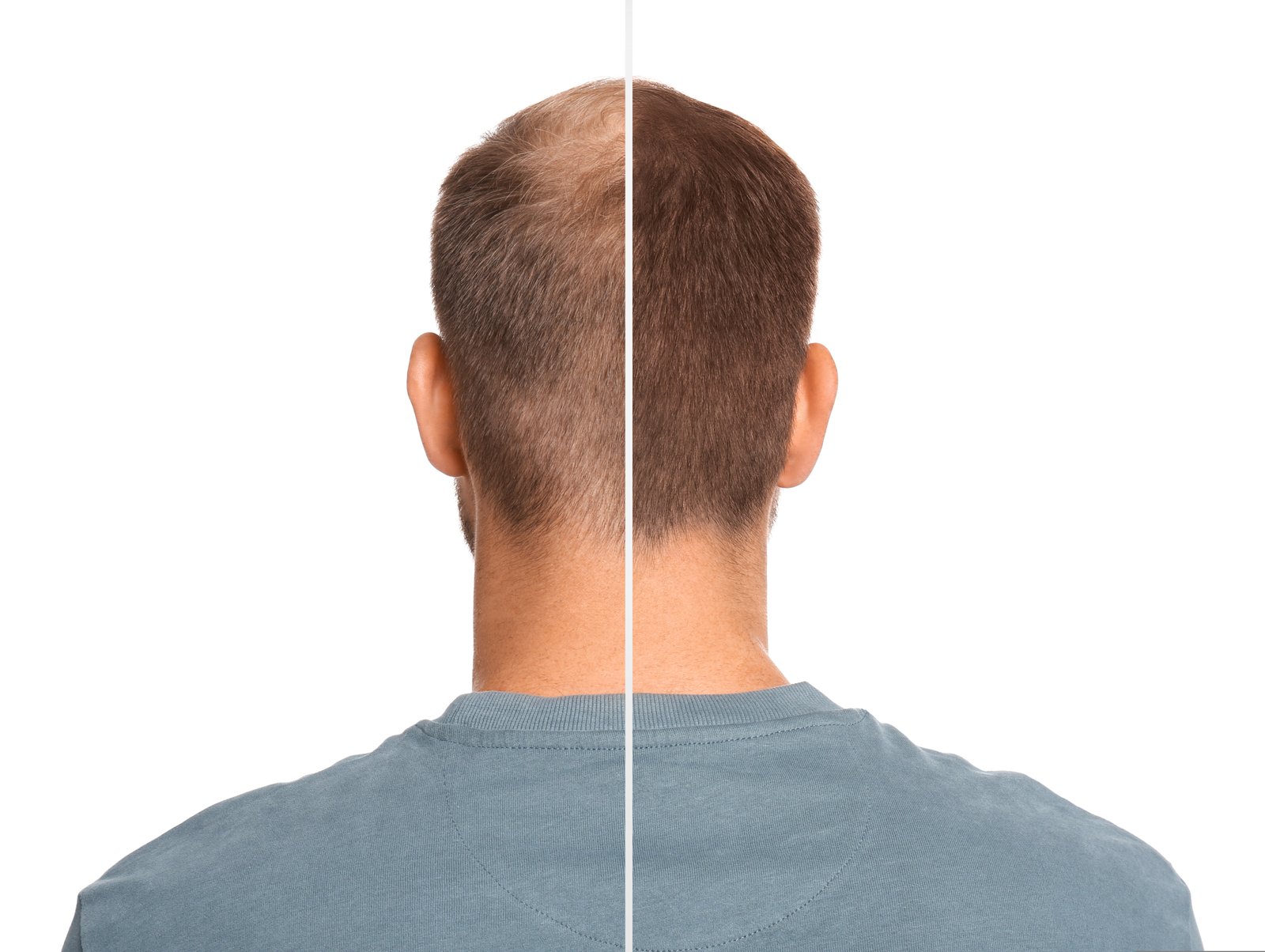 Hair Transplant in Jodhpur | Best Hair Transplant Clinic in Jodhpur