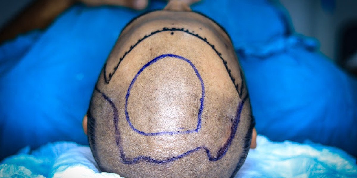 Hair transplant clinic in Udaipur