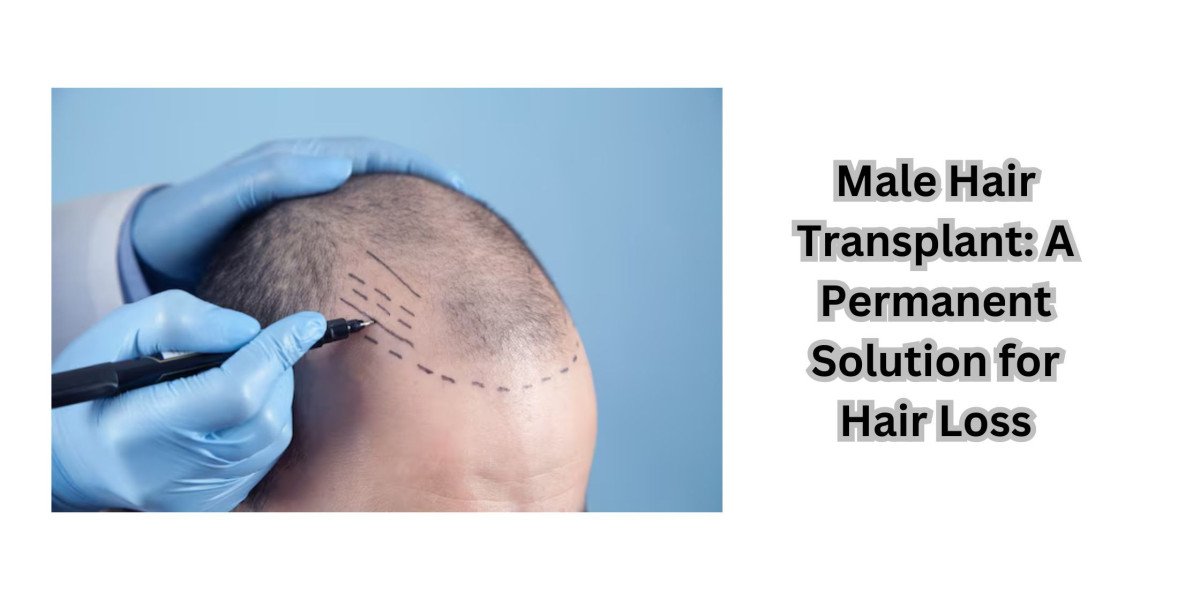 Male Hair Transplant: A Permanent Solution for Hair Loss